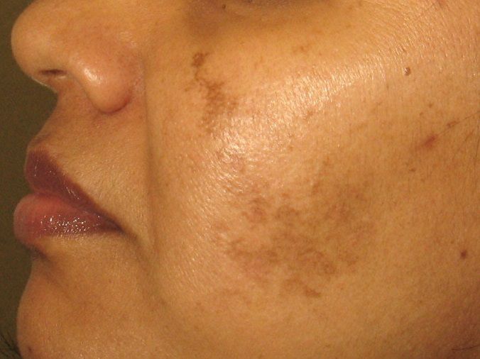 Skin Pigment From Acne In Susceptible Individuals