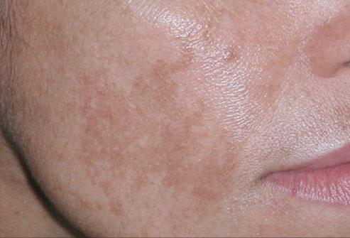 hyperpigmentation after acne on skin